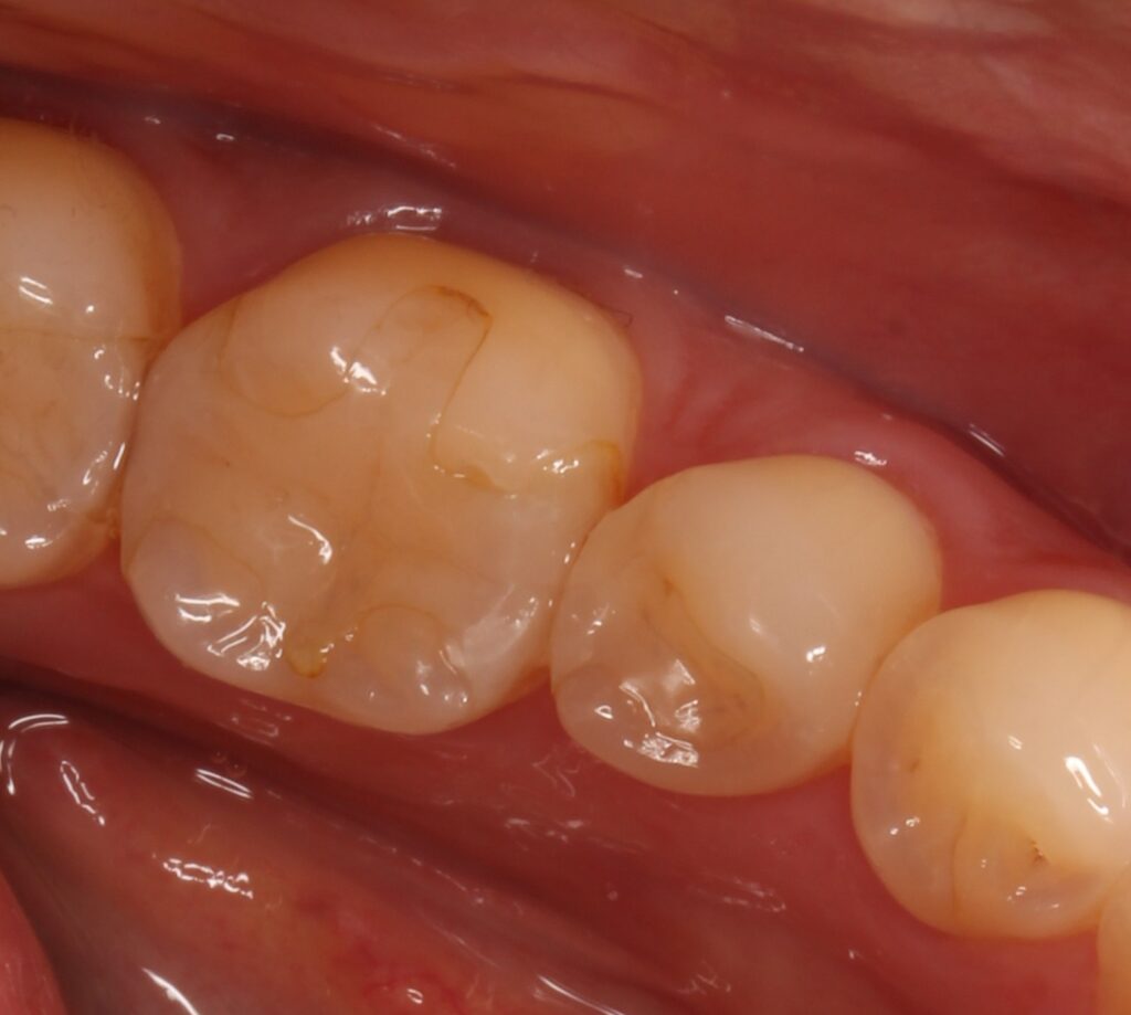 セラミック欠けた　割れた　セラミックインレー