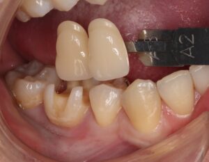 虫歯 セラミック インレー
