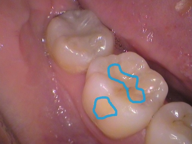 虫歯 セラミック インレー