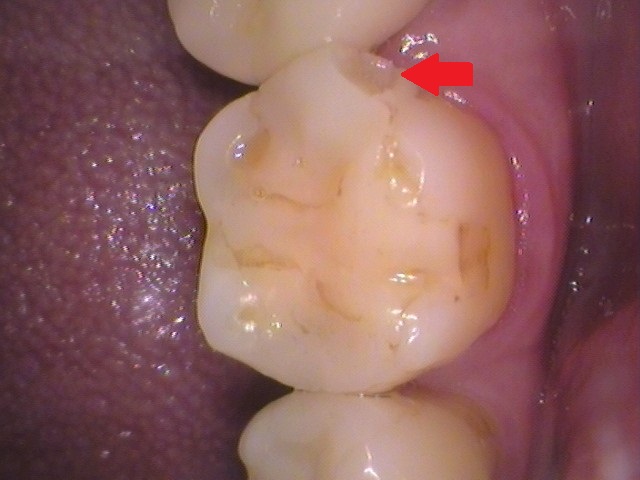 ハイブリッドセラミックインレー