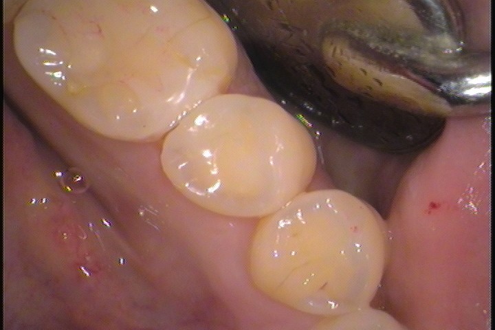 セラミック欠けた　割れた　セラミックインレー