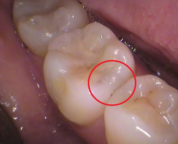 虫歯 セラミック インレー