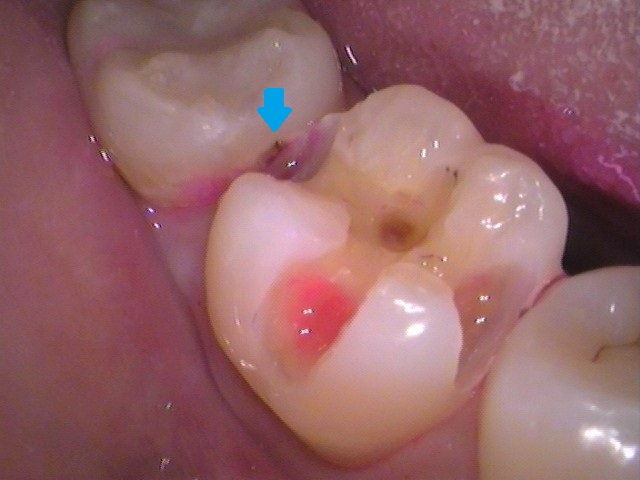 虫歯 セラミック インレー