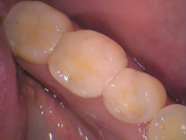 セラミック欠けた　割れた　セラミックインレー