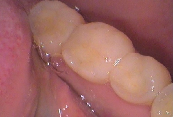 セラミック欠けた　割れた　セラミックインレー