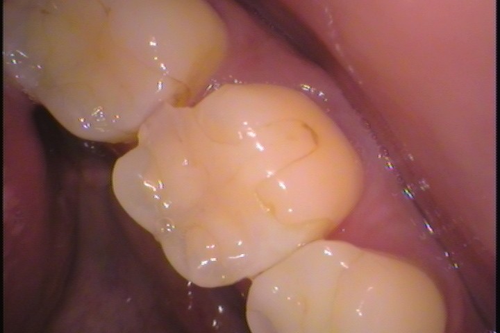 セラミック欠けた　割れた　セラミックインレー