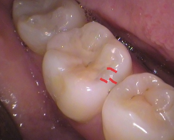 虫歯 セラミック インレー
