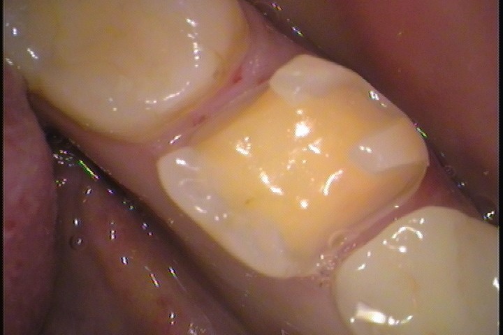 セラミック欠けた　割れた　セラミックインレー