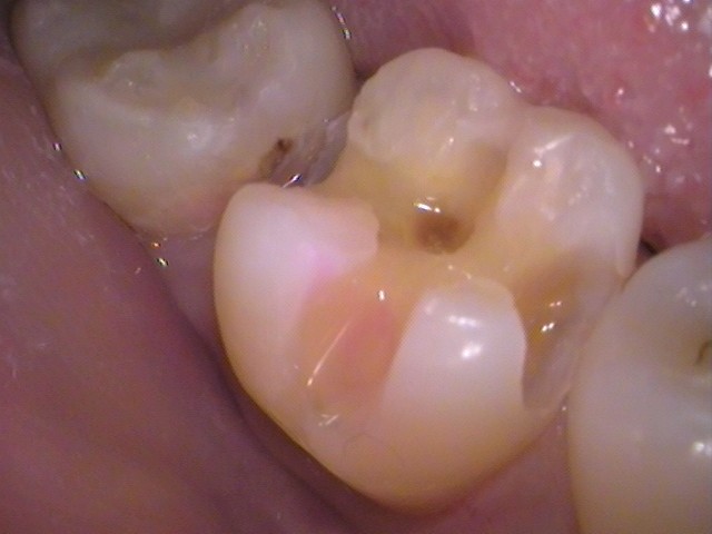 虫歯 セラミック インレー