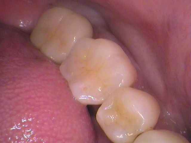 ハイブリッドセラミックインレー