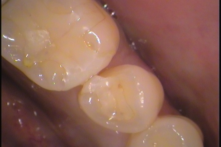 セラミック欠けた　割れた　セラミックインレー