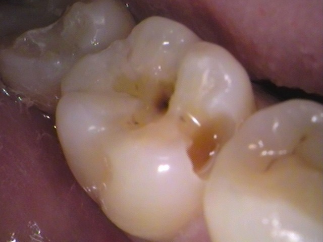 虫歯 セラミック インレー