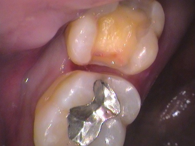 銀歯　歯が欠けた　セラミック治療　自由が丘　歯医者