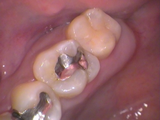 銀歯　歯が欠けた　セラミック治療　自由が丘　歯医者