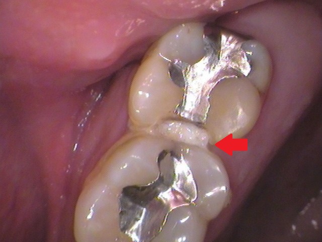 銀歯　歯が欠けた　セラミック治療　自由が丘　歯医者