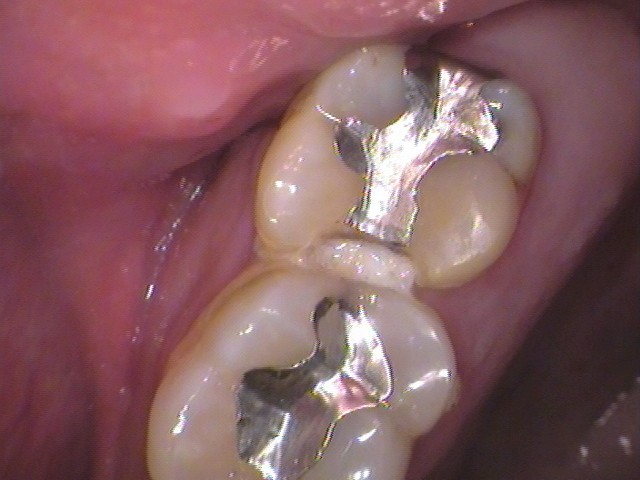 銀歯　歯が欠けた　セラミック治療　自由が丘　歯医者