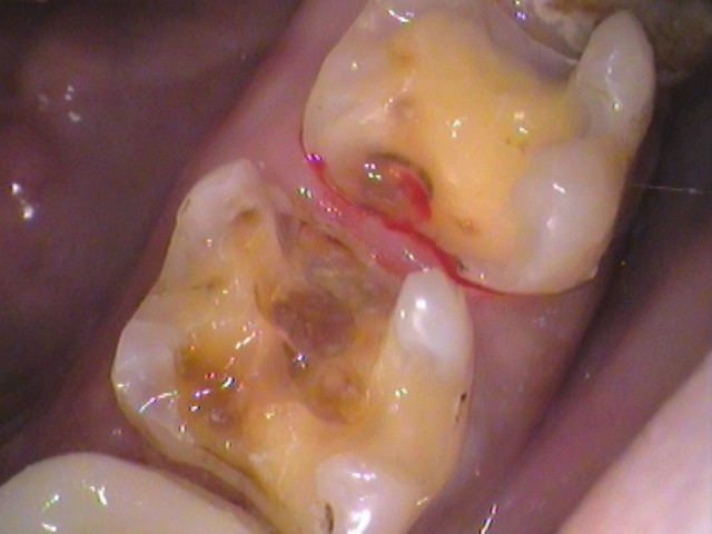 銀歯　虫歯　セラミック治療　自由が丘　歯医者