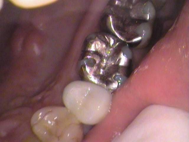 銀歯　虫歯　セラミック治療　自由が丘　歯医者