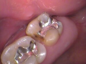 銀歯　歯が欠けた　セラミック治療　自由が丘　歯医者