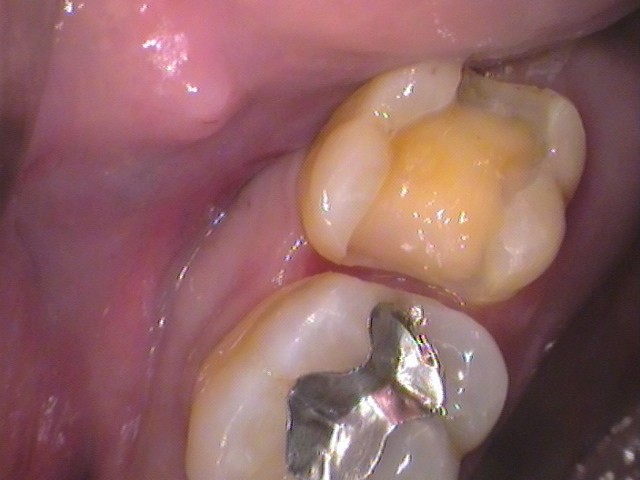 銀歯　歯が欠けた　セラミック治療　自由が丘　歯医者
