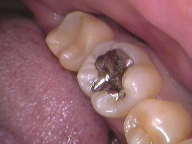 詰め物が取れた　セラミック治療　自由が丘　歯医者