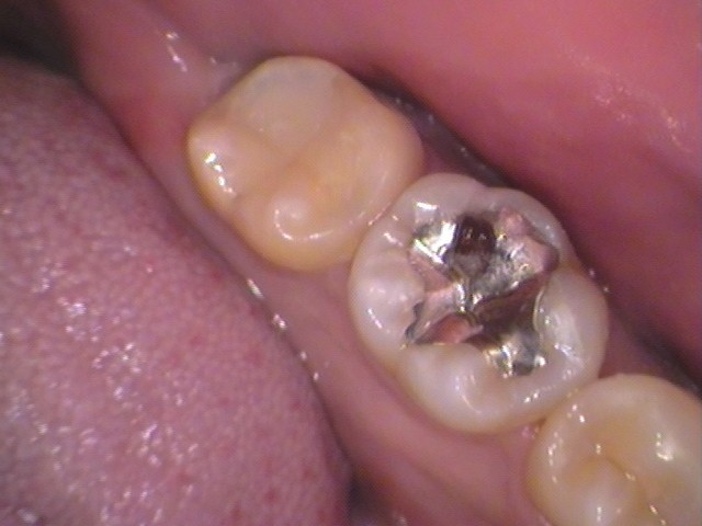 詰め物が取れた　セラミック治療　自由が丘　歯医者