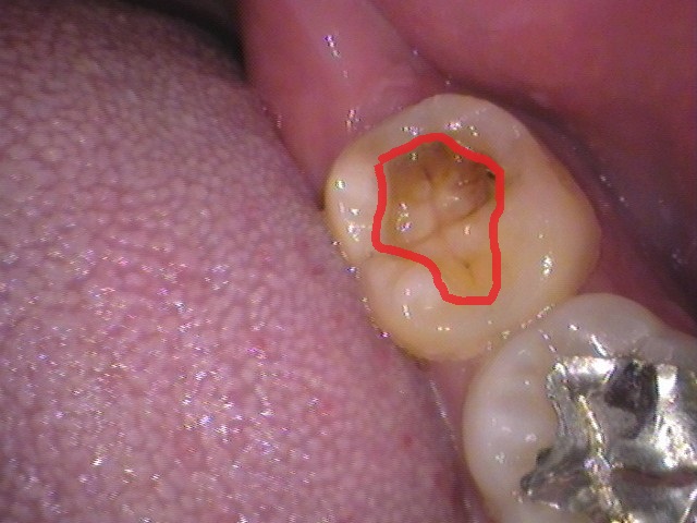 詰め物が取れた　セラミック治療　自由が丘　歯医者