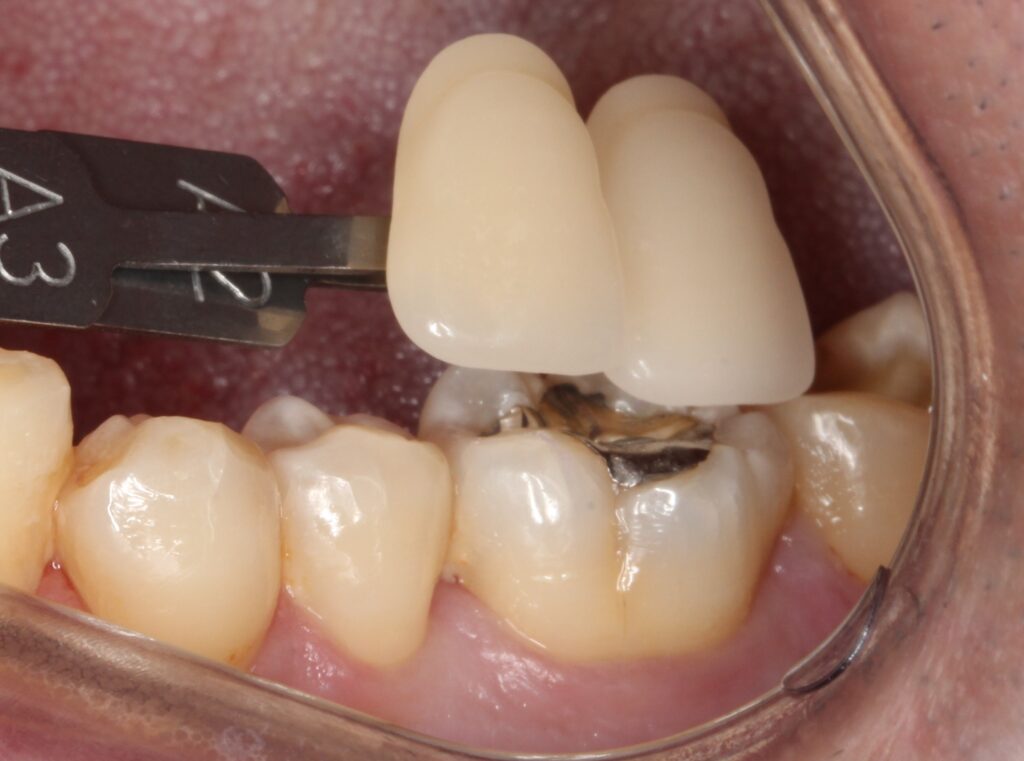 詰め物が取れた　セラミック治療　自由が丘　歯医者