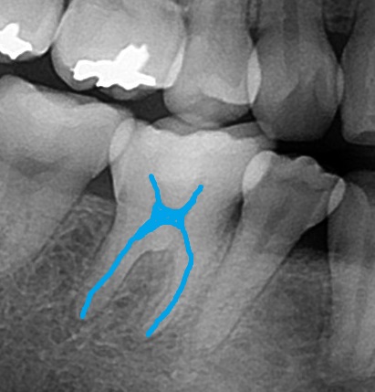 レジン充填と歯の神経レントゲン