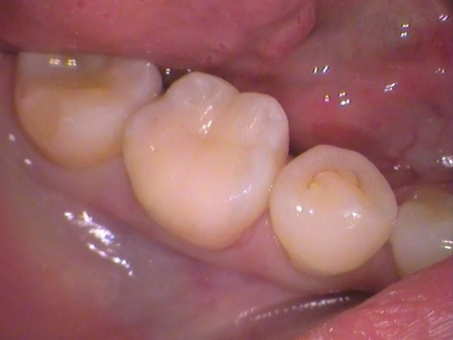 セラミックインレーをセット