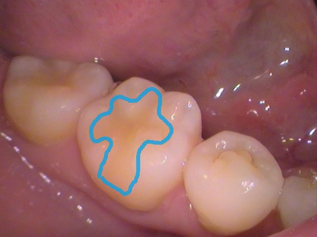 黄色い古いレジン