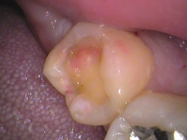 詰め物が取れた　セラミック治療　自由が丘　歯医者