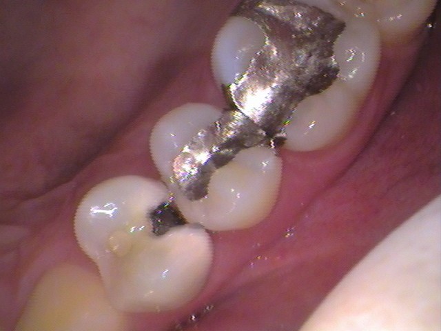 MTAセメント　虫歯　歯医者　自由が丘