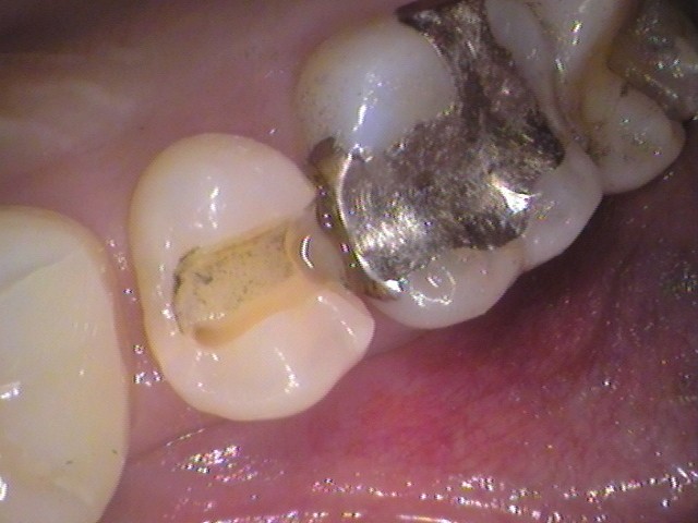 MTAセメント　虫歯　歯医者　自由が丘