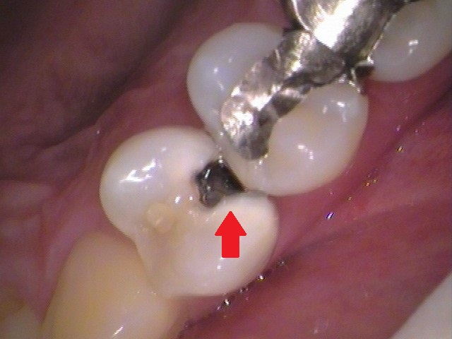 MTAセメント　虫歯　歯医者　自由が丘