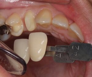 MTAセメント　虫歯　歯医者　自由が丘