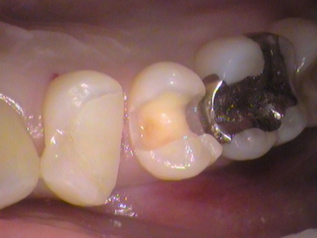 MTAセメント　虫歯　歯医者　自由が丘