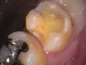 銀歯　虫歯　セラミック　自由が丘　歯医者