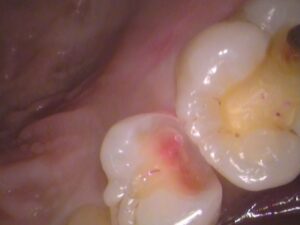 虫歯　セラミック　歯医者　自由が丘