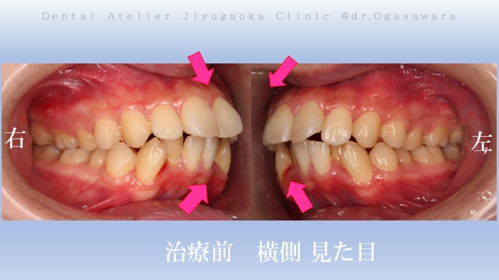 矯正　歯並び　出っ歯　ガタガタ　歯医者　自由が丘