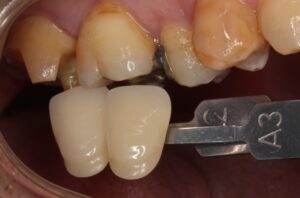 銀歯　虫歯　セラミック　自由が丘　歯医者