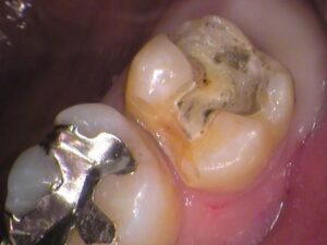 銀歯　虫歯　セラミック　自由が丘　歯医者