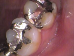 銀歯　虫歯　セラミック　自由が丘　歯医者