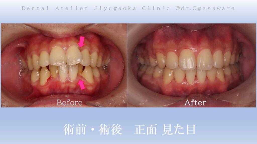 矯正　歯並び　出っ歯　ガタガタ　歯医者　自由が丘