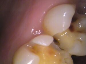 虫歯　セラミック　歯医者　自由が丘
