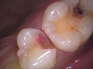 虫歯　セラミック　歯医者　自由が丘