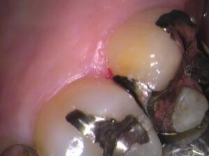 銀歯　虫歯　セラミック　自由が丘　歯医者