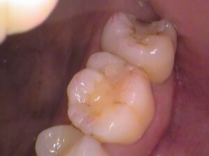 虫歯　セラミック　歯医者　自由が丘