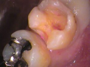 銀歯　虫歯　セラミック　自由が丘　歯医者