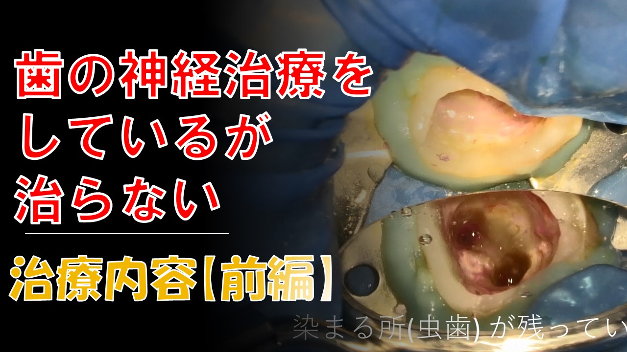 根管治療　治らない